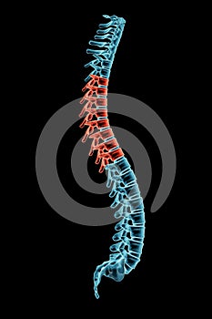 X-ray spinal column with kyphosis posture and pathological vertebrae highlighted in red. Human curvature of the spine disorder 3D