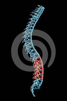 X-ray spinal column with lordosis posture and pathological vertebrae highlighted in red. Human curvature of the spine disorder 3D