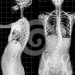 X-ray of the Spinal Column and Pelvis.