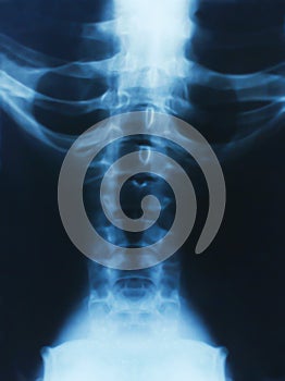 X-ray of the spine