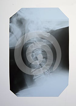 X-ray of the spine and cervical spine