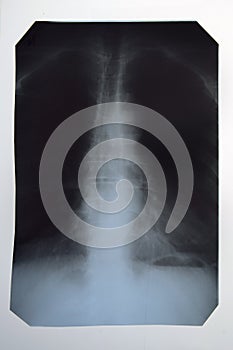 X-ray of the spine and cervical spine