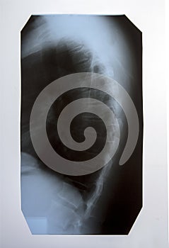 X-ray of the spine and cervical spine