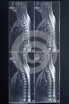 X-ray spine and neck radiography