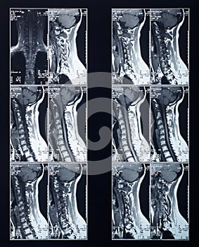 X-ray spine and neck radiography