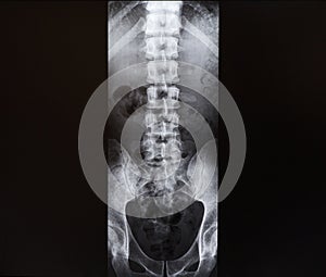 X-ray of the spine and pelvis