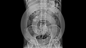 X ray of stag horns stone or renal calculi in right kidney.