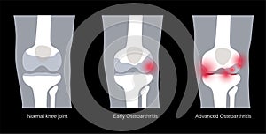 Arthritis in knee joint