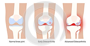 Arthritis in knee joint