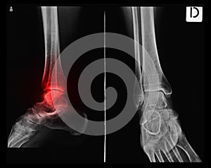 X-ray tarsal, ankle and foot with red painful area photo