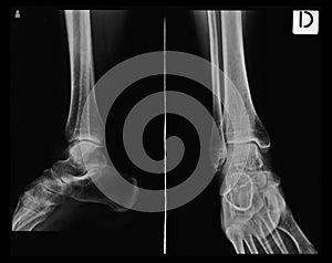 X-ray tarsal, ankle and foot. photo