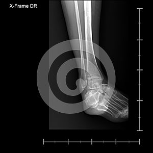 X-ray tarsal and ankle front. photo