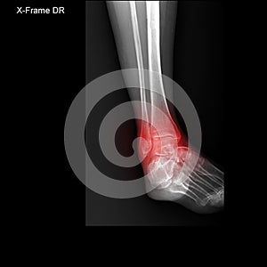 X-ray tarsal and ankle painful area. photo