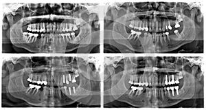 X ray of teeth