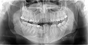X-ray teeth photo