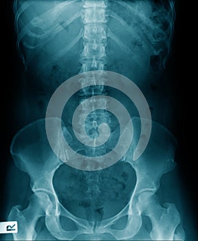 X-ray thoraco-lumbar human structure with pelvic bone