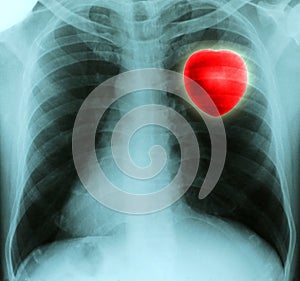 X-ray of a thorax