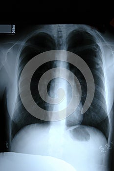 X-ray of Torso photo
