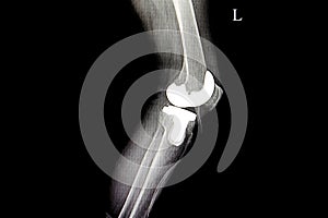 x-ray total knee replacement