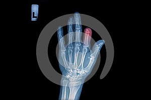 X-ray of trauma hand