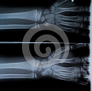 X Ray of two hands and forearm
