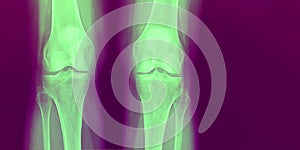 X-Ray of two healthy knee bones in green and purple