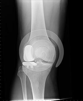 X ray of a unilateral knee replacement photo