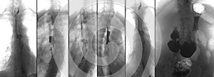 X-ray of the upper gastrointestinal series UGI with barium. Cancer of the esophagus. Negative. photo