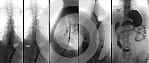 X-ray of the upper gastrointestinal tract UGI with barium. Hiatal hernia. Negative. Marker. photo