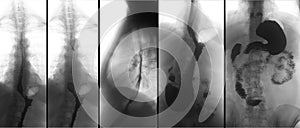 X-ray of the upper gastrointestinal tract UGI with barium. Hiatal hernia. Negative. photo