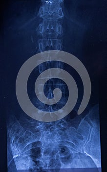 X ray of Vertebrae - Spinal column.