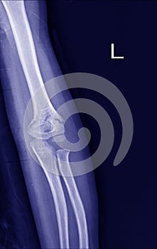 X-ray view of elbow on a black background