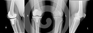 X-ray view knees. Right - Total knee replacement show metallic joint implant in bone and left knee - Osteoarthritis.