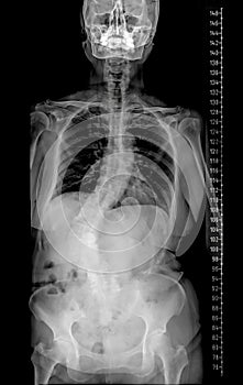 X-ray of Whole Spine for diagnosis scoliosis with scale left side.