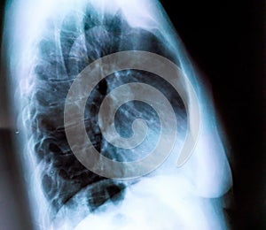 X-ray of a woman patient`s lungs with pronounced traces of the inflammatory process