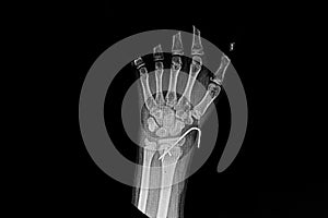 X-ray wrist AP that show fracture distal radius. photo