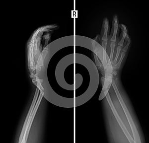 X-ray of the wrist. Greenstick fracture of the radius.