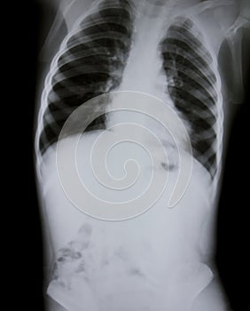 X-ray of young boy.