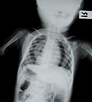 X-ray of young boy.