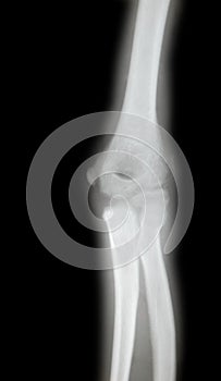 X-ray of a young mans arm