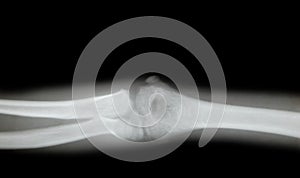 X-ray of a young mans arm
