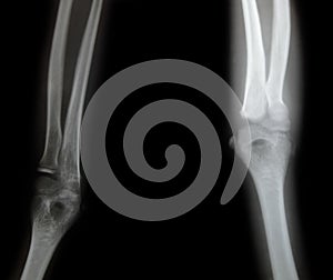 X-ray of a young mans arm