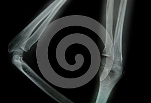 X-ray of a young people arm