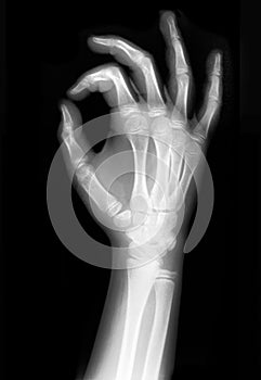 X-rayed Hand