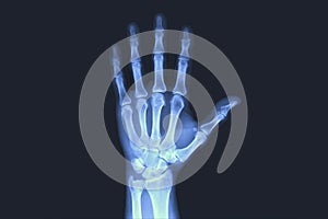 X-rayed human hand. X-ray of hand bones.