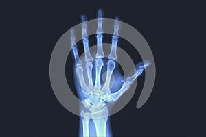 X-rayed human hand.