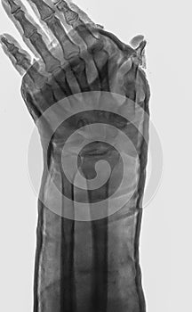 X-rayed human left hand. X-ray of hand bones