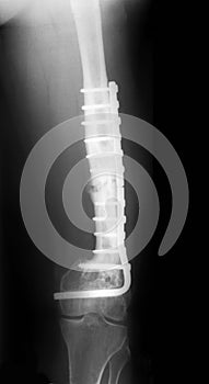 X-Rayed Thigh photo