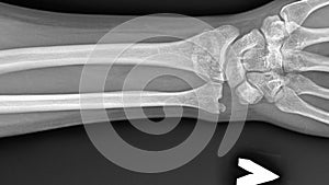 X-rays of a broken arm. Human Anatomy, image of a bone injury with displacement