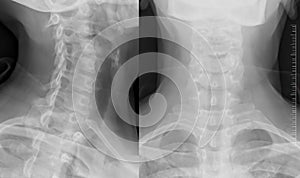 X-rays of human neck photo